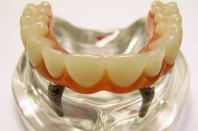 Зубные имплантаты признали опасными